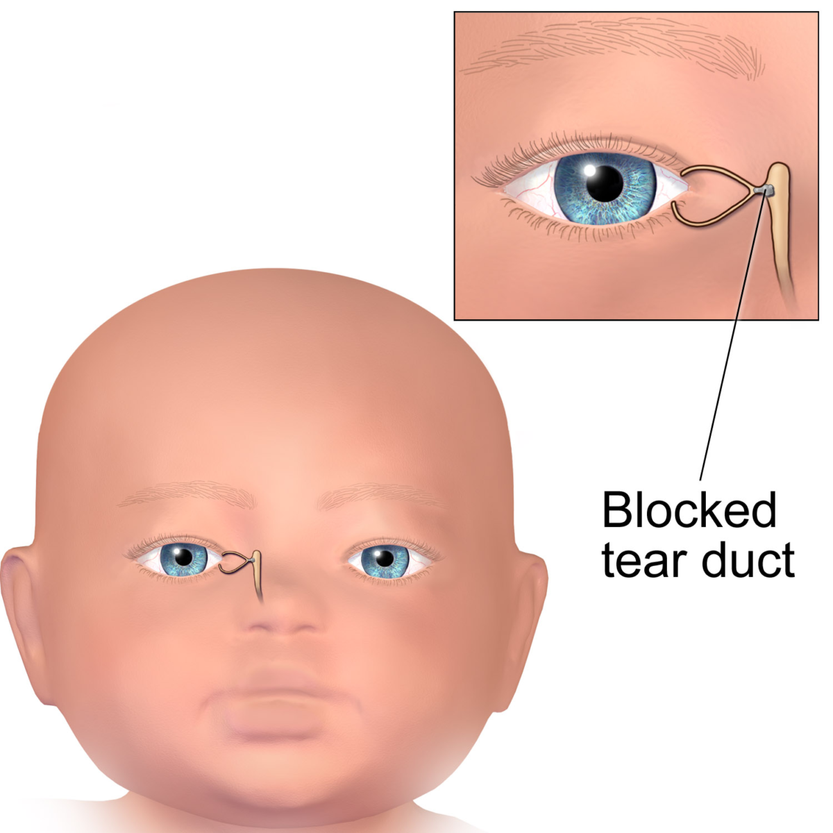 Когда необходимо и как делают зондирование слёзного канала у новорождённых + видео