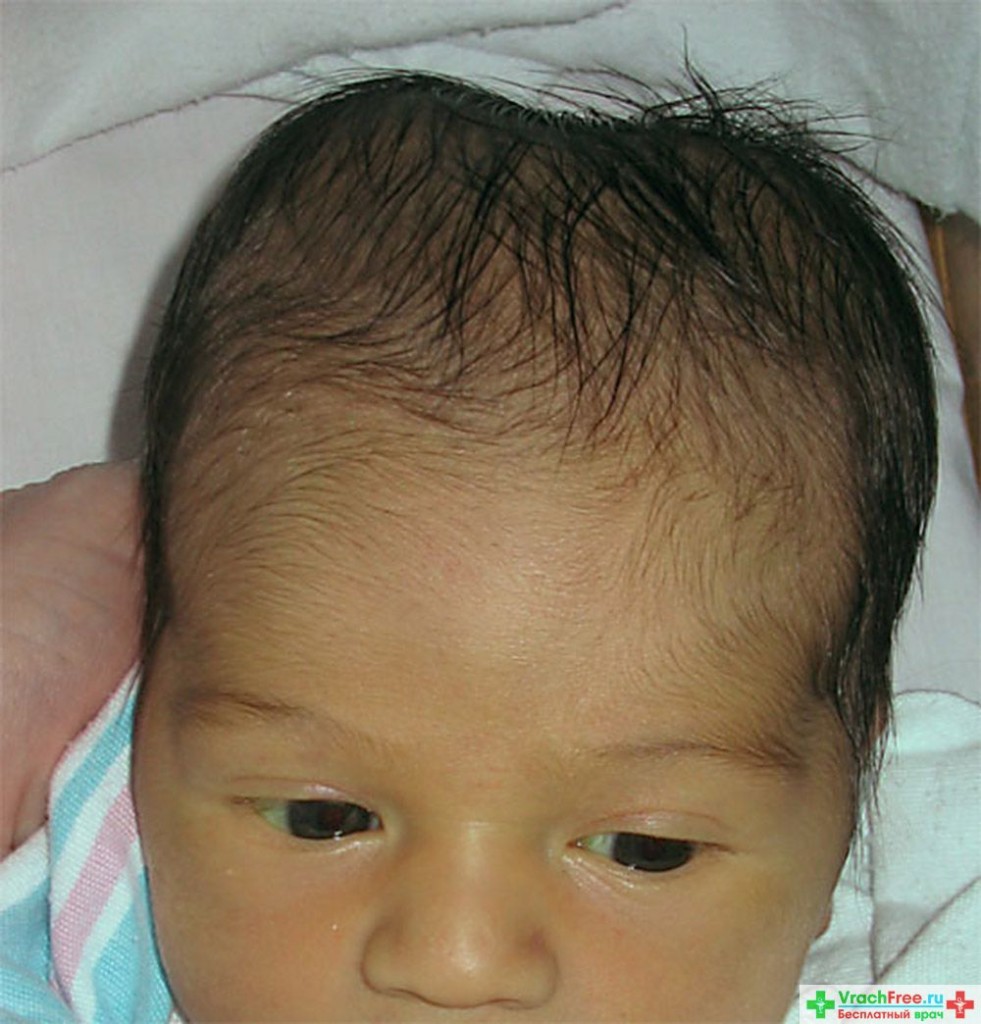 Причины, диагностика и лечение кефалогематомы у новорождённого ребёнка