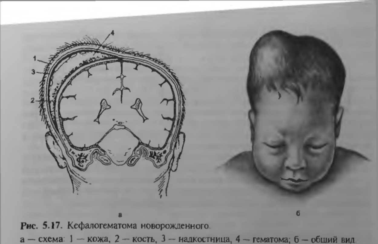 Кефалогематома у новорожденных на голове: последствия, лечение