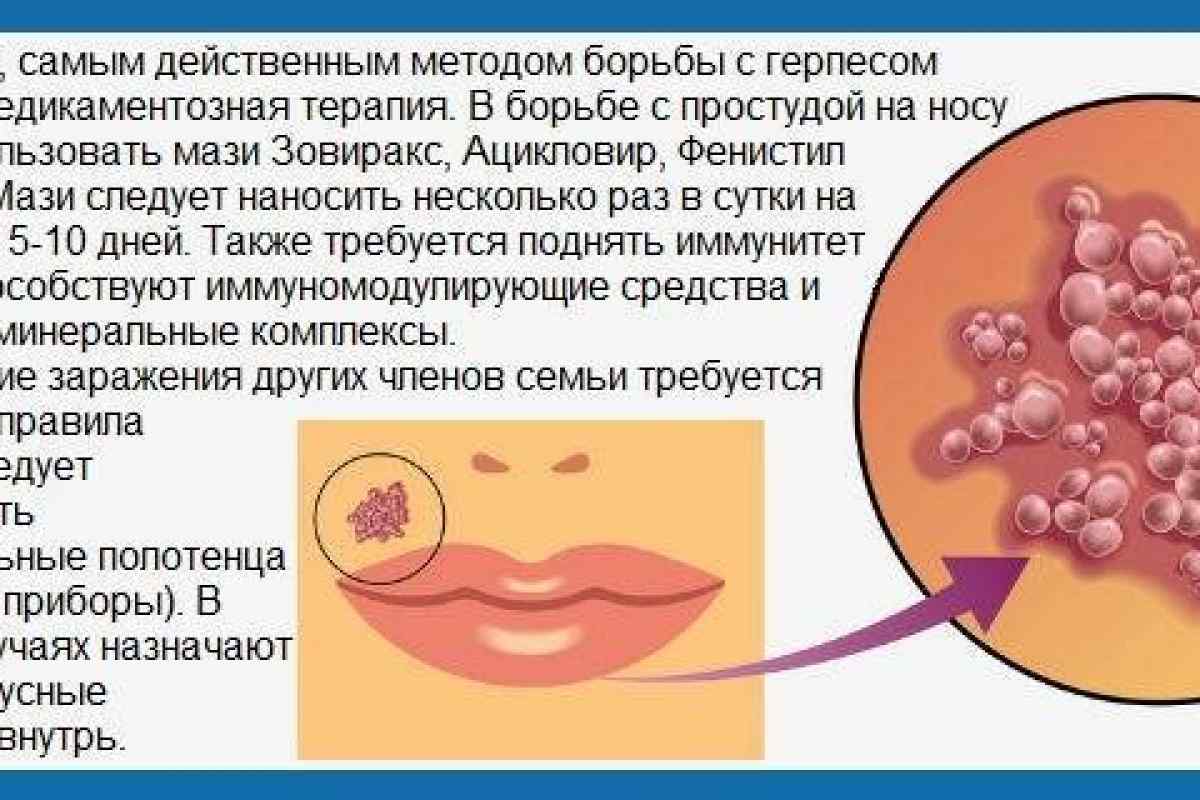 Как проявляется герпес на теле у ребёнка и подходы к его лечению освещает в своей статье врач-педиатр