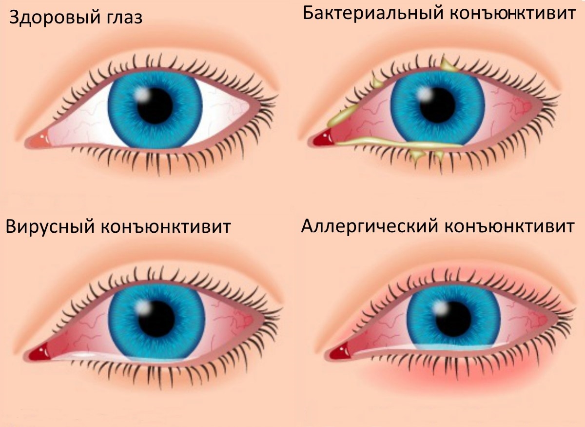 Аллергический конъюнктивит у детей: 7 основных причин и 5 способов лечения
