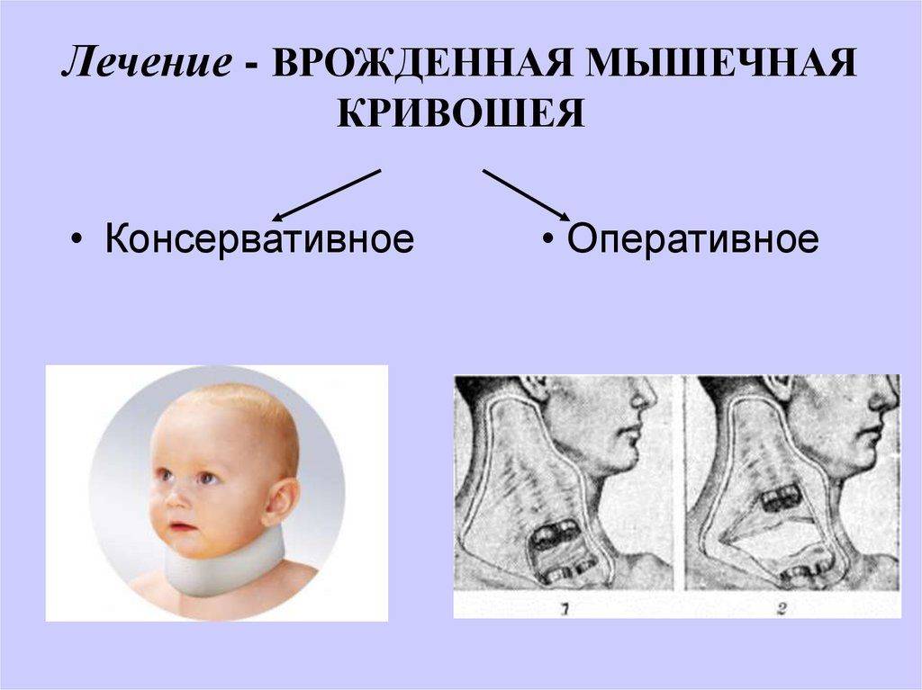 Кривошея у новорожденных: признаки у грудничка в 3 месяца, как исправить, основные симптомы