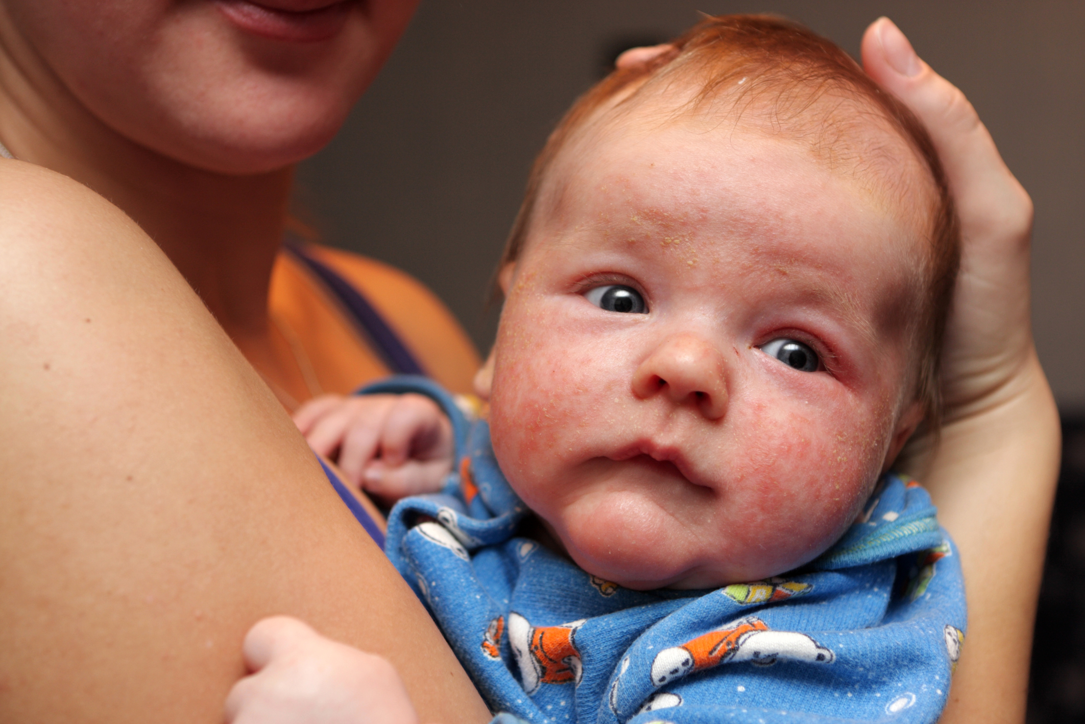 Опасности стафилококка у новорожденных и советы по его лечению
