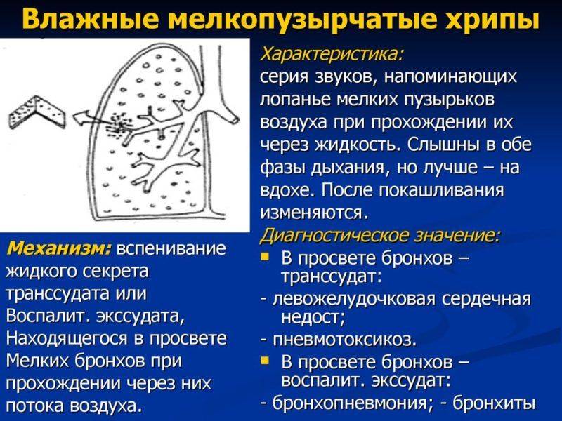 Хриплое дыхание у новорожденных. стридор