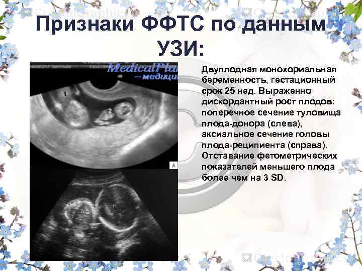 Беременность двойней: признаки и развитие плодов по неделям, ощущения