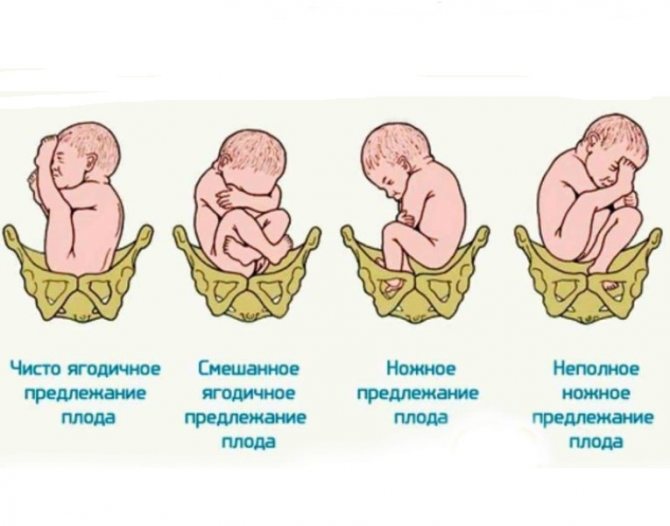 Водянка яичек у новорожденных мальчиков
