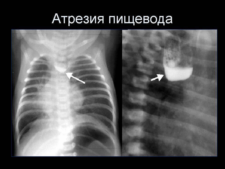 Лечение атрезии пищевода, ее причины и симптомы