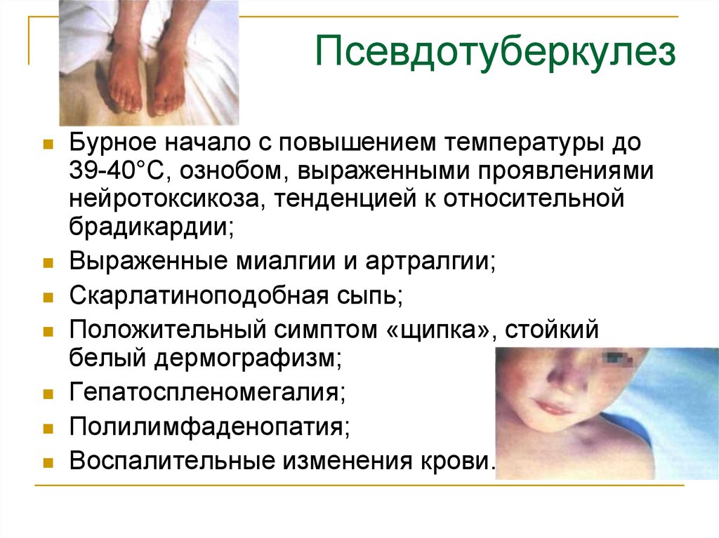 Псевдотуберкулёз - статьи - клиника «c нуля» (здоровая семья)