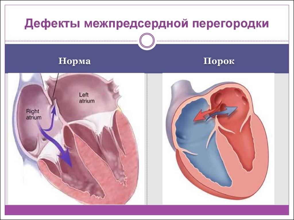 Открытое овальное окно в сердце: причины, симптомы, лечение и прогнозы