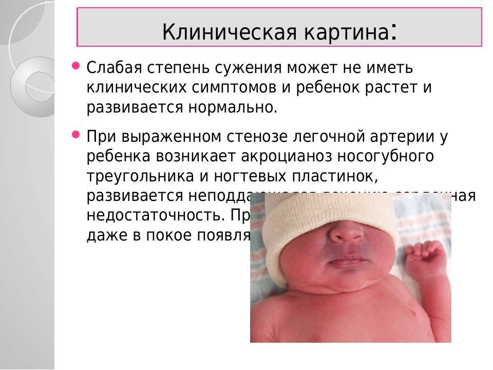 Врожденный порок сердца у новорожденных — классификация, симптомы, лечение
