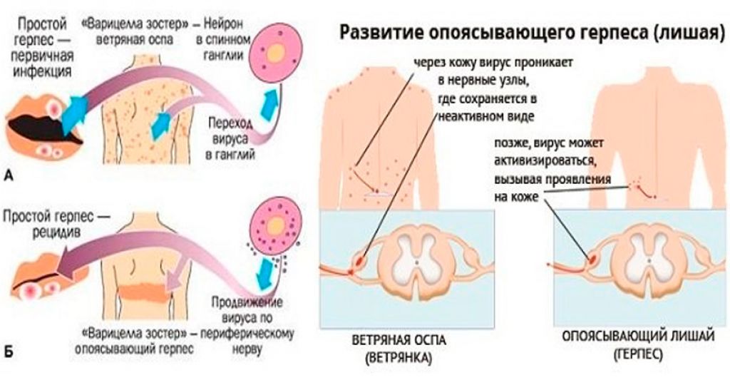 Герпес 6 типа у детей – пути передачи, симптоматика, лечение