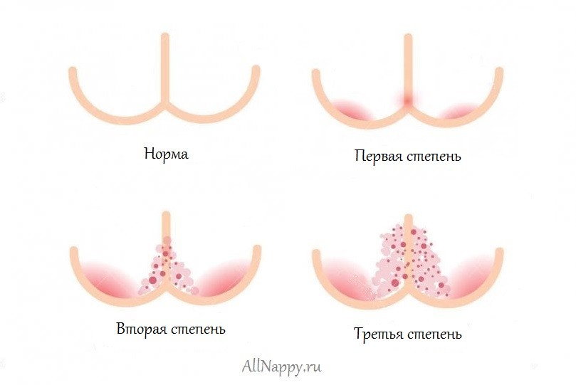 Опрелости у новорожденных детей: причины появления, профилактика