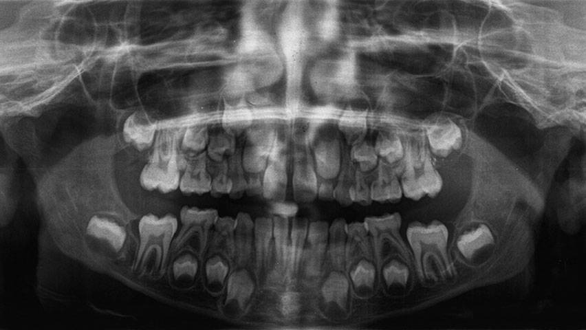 Стоит ли делать рентген зуба при беременности?