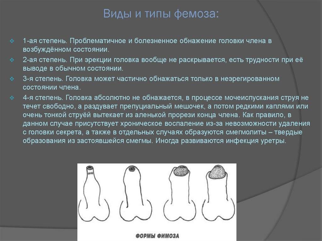 Как открыть головку у мальчика без боли — правильные действия