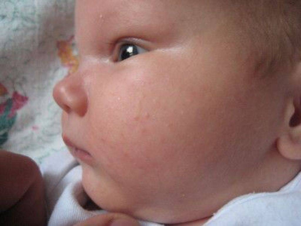 Что означают прыщики на лице, голове и теле у новорожденного? мелкая белая, красная сыпь и гнойнички у грудничка
