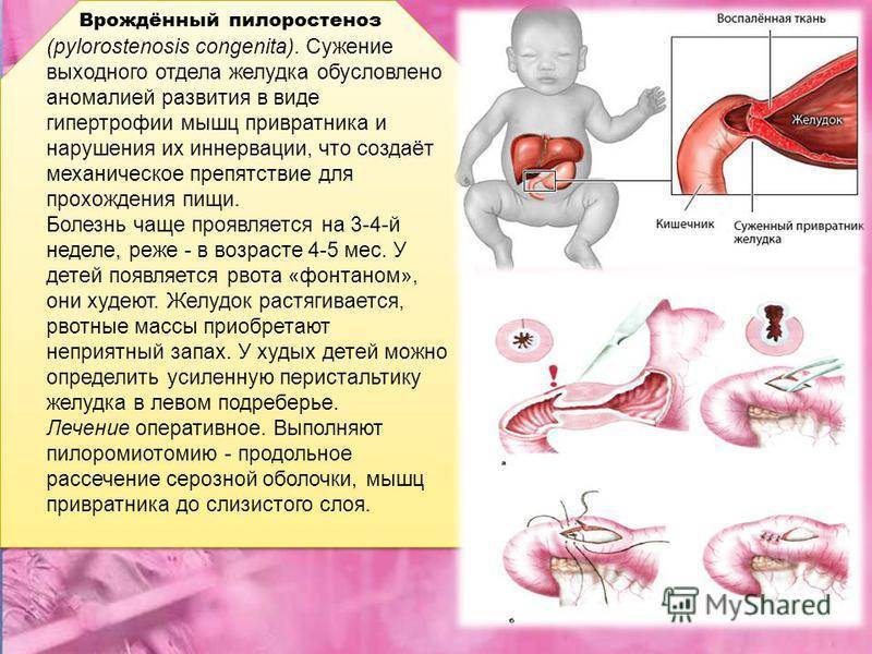 Пилоростеноз врожденный презентация