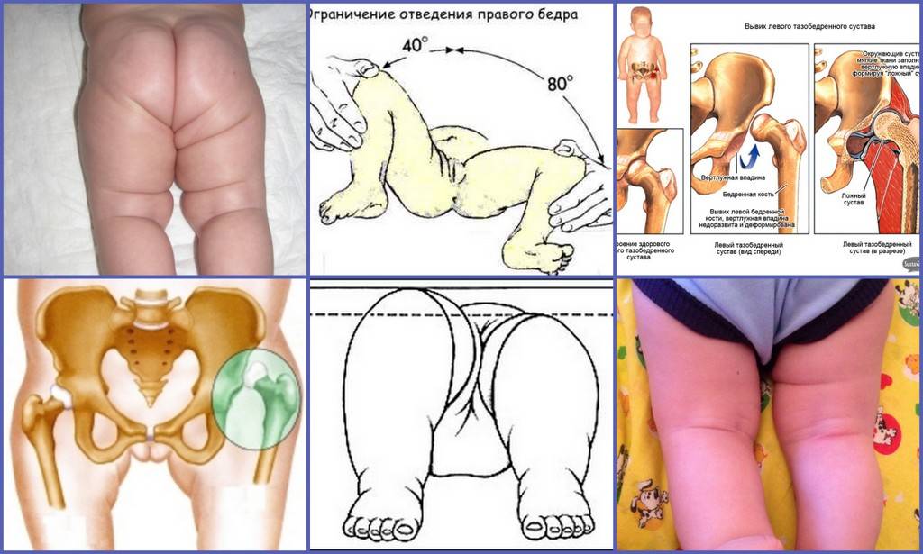 Дисплазия тазобедренных суставов у новорожденных и грудничков: причины, лечение