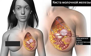 Киста молочной железы - лечение, симптомы | азбука здоровья