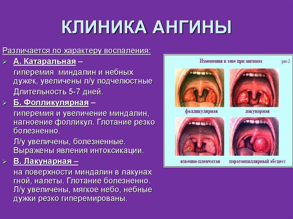 Что можно кормящим от горла. как правильно лечить горло при грудном вскармливании. методы лечения для кормящей мамы