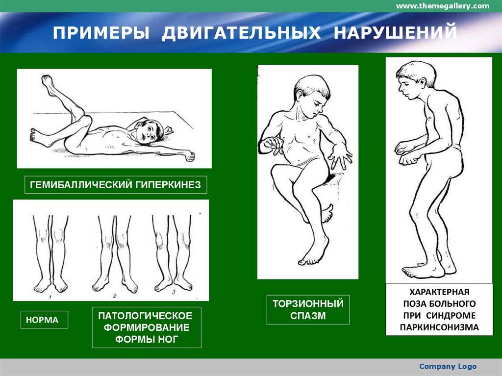 Дцп у грудничков – как распознать ранние проявления | малыш здоров!
