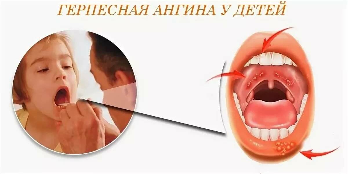 Особенности герпетической ангины: симптоматика, причины возникновения, лечение - лор клиника в чертаново