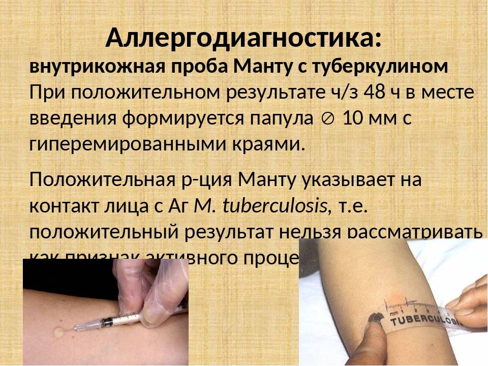 На какой день проверяют манту у ребенка