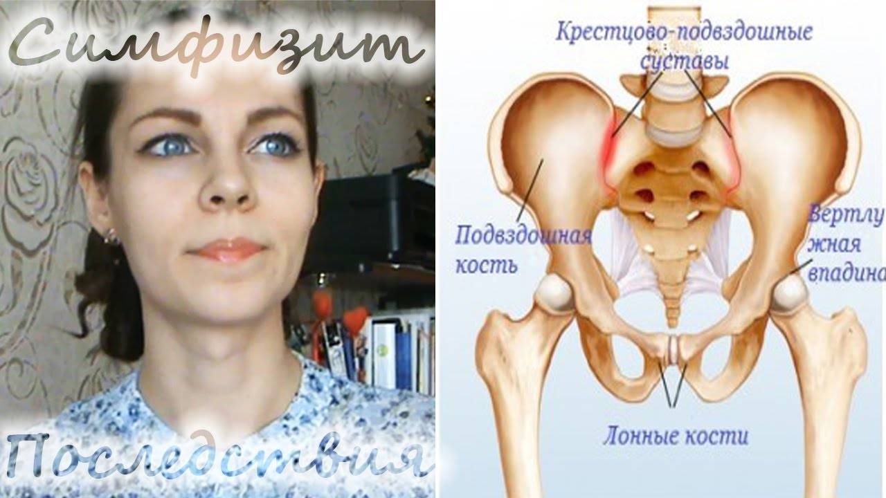 Болят кости лобковые причины