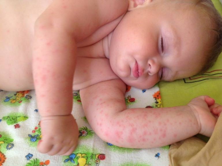 Как отличить аллергию от цветения у новорожденных – отличие симптомов
