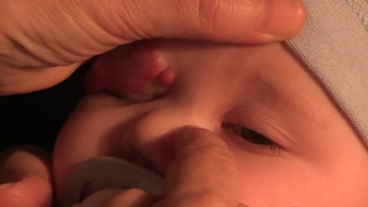 Зондирование, или бужирование, слезного канала у детей до года и новорожденных при дакриоцистите: как это происходит?