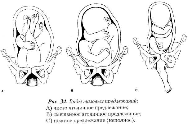 Ведение родов при тазовом предлежании