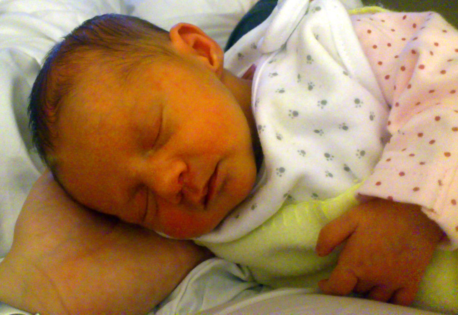 Желтуха у новорожденных: 5 симптомов, 10 причин, 3 способа лечения, профилактика