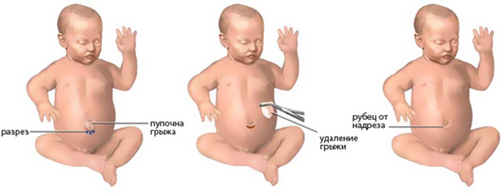 Пупочная грыжа у новорожденных - причины возникновения, симптомы, лечение и профилактика