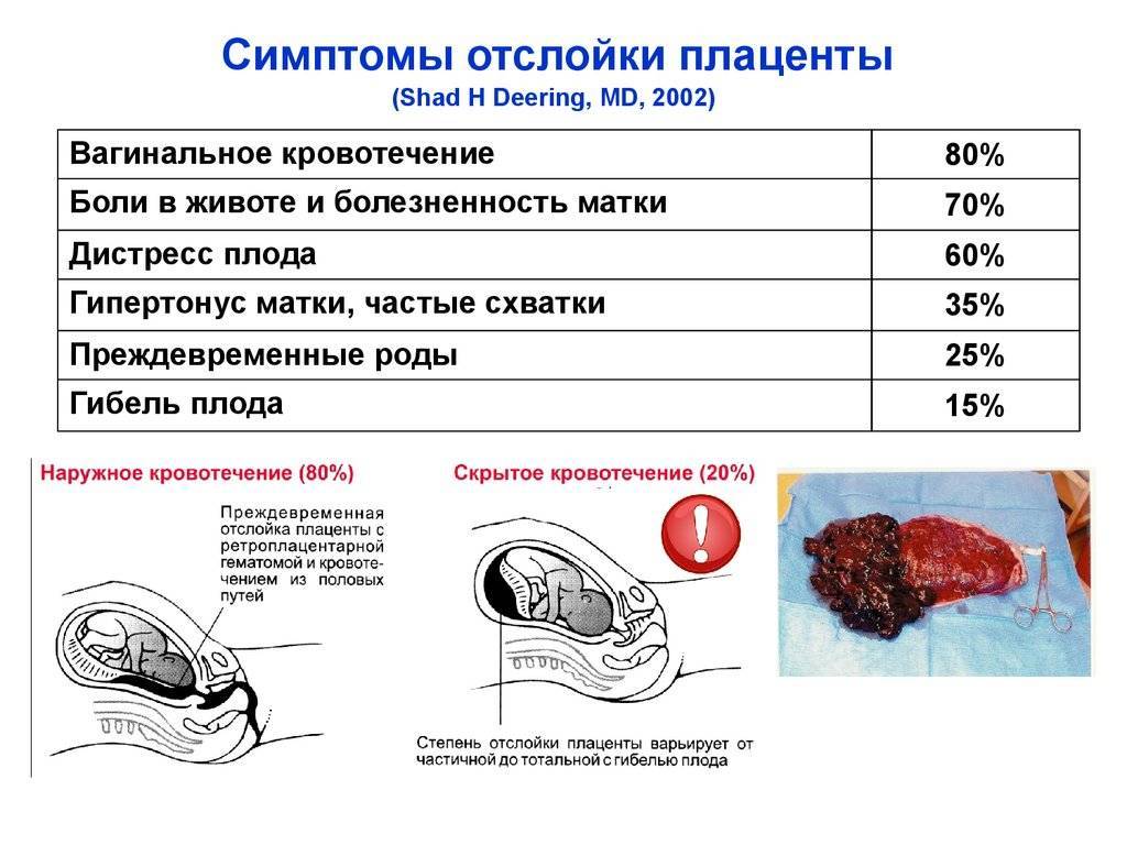 Преждевременная отслойка плаценты: причины, симптомы, диагностика и лечение