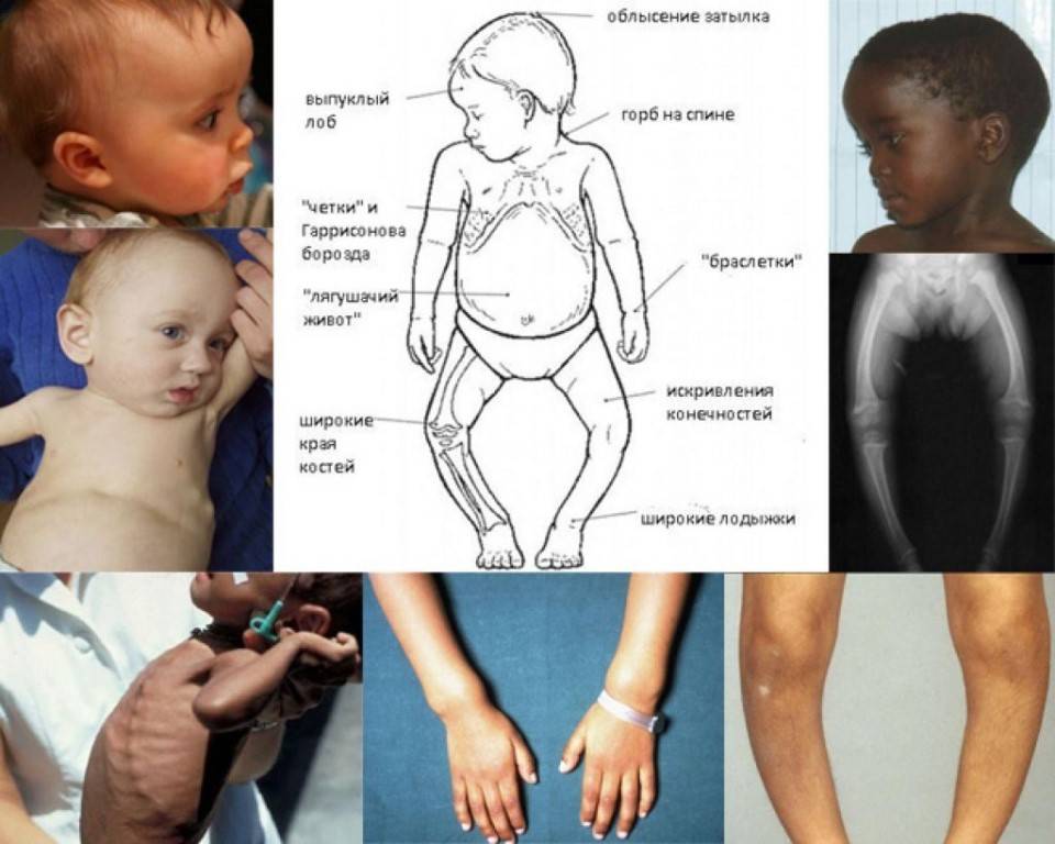 Рахит у грудничков (детей до года): признаки и симптомы рахита, лечение, профилактика (витамины), последствия рахита
