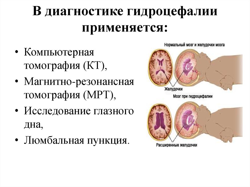 Диагноз гидроцефалии. Клинические симптомы гидроцефалии. Гидроцефалия, клинические проявления, причины.. Острая обструктивная гидроцефалия.