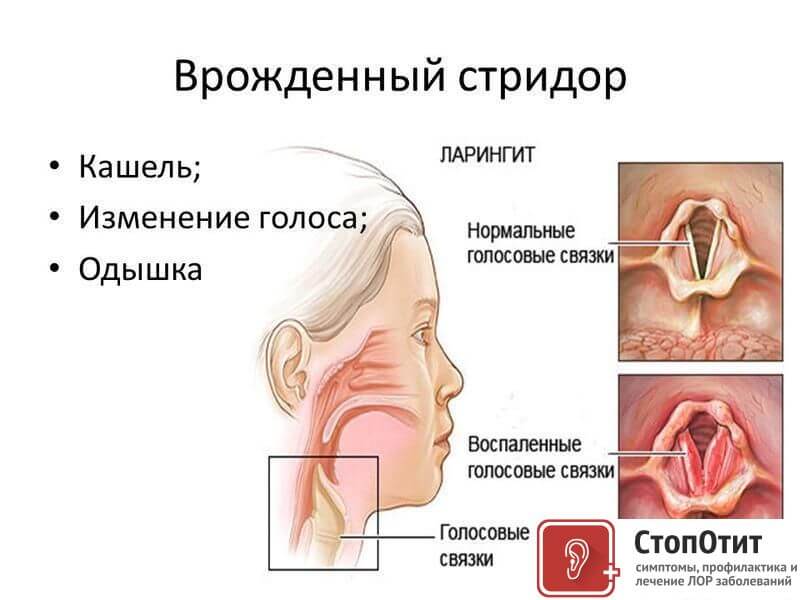2 метода лечения стридорозного дыхания у детей