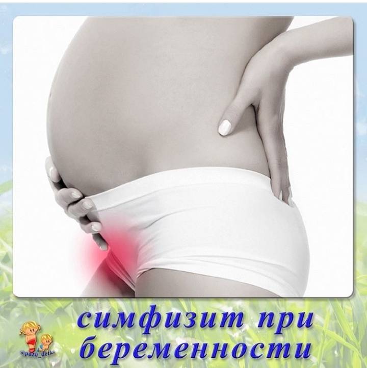 Симфизит при беременности | уроки для мам