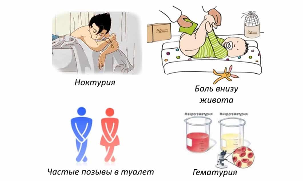 Цистит у детей: симптомы и лечение / mama66.ru