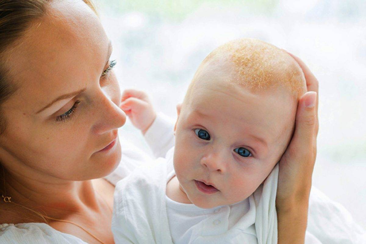 Корочки на голове у грудничка: как убрать у младенца по комаровскому, как удалить желтые чешуйки и коросты у ребенка