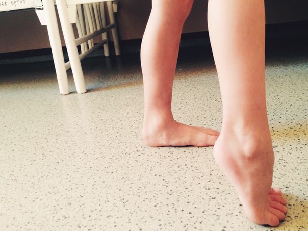 Ребенок 9 лет ходить на носочках, как лечить?