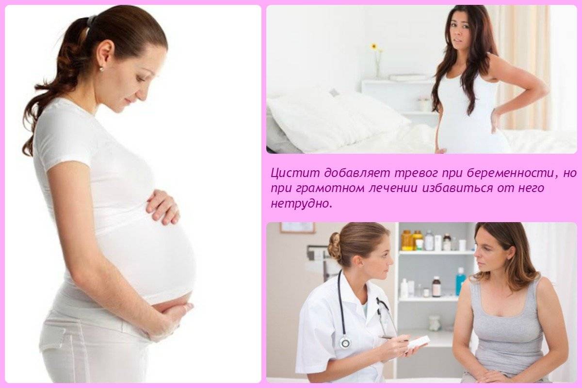 Цистит во время беременности