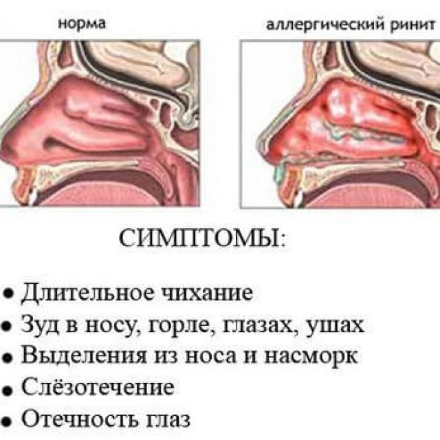 Можно ли на улицу с насморком. стоит ли гулять на улице с насморком
